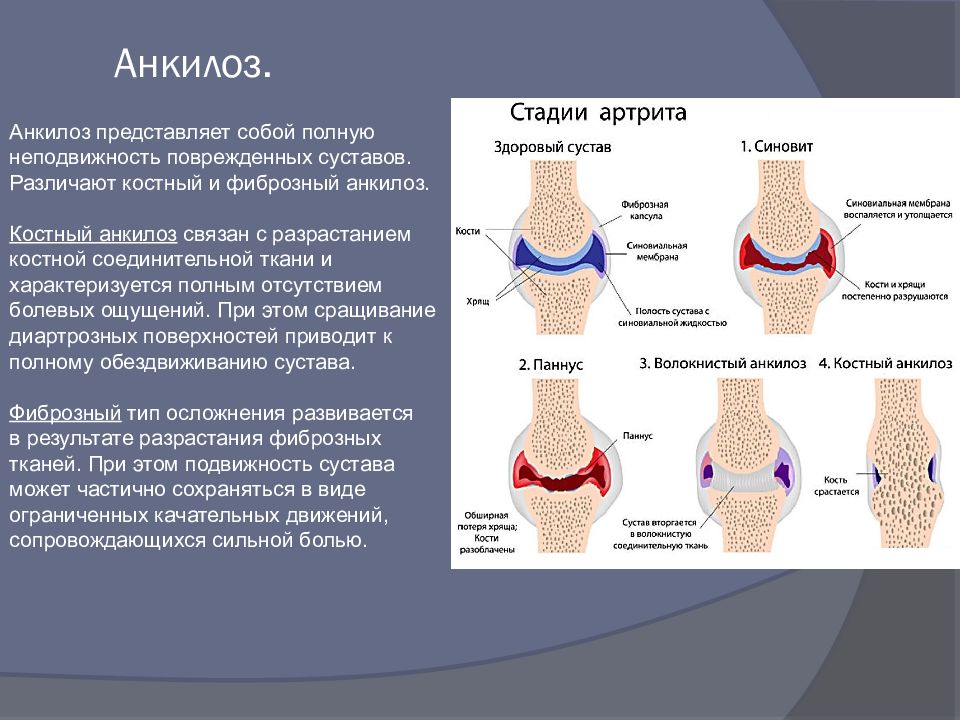 Анкилоз лечение