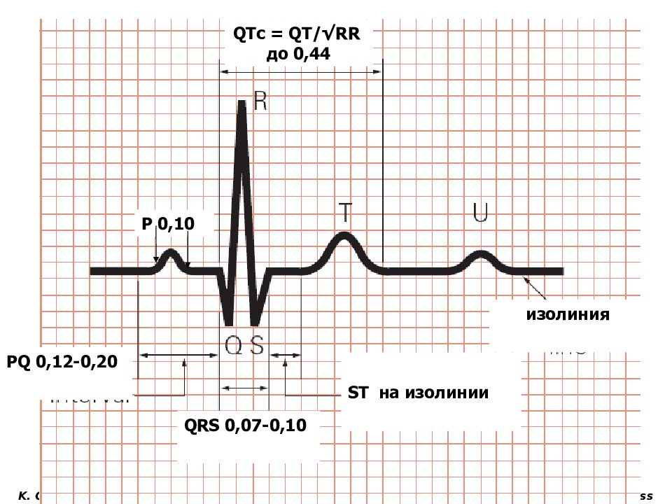 Qrs 0 09. Ось QRS норма ЭКГ. QRS норма ЭКГ. Зубец QRS на ЭКГ норма. Нормальные показатели зубцов и интервалов ЭКГ.