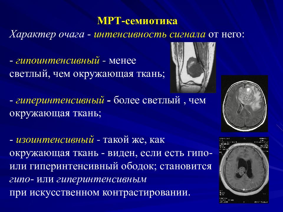 Т1 взвешенное изображение мрт