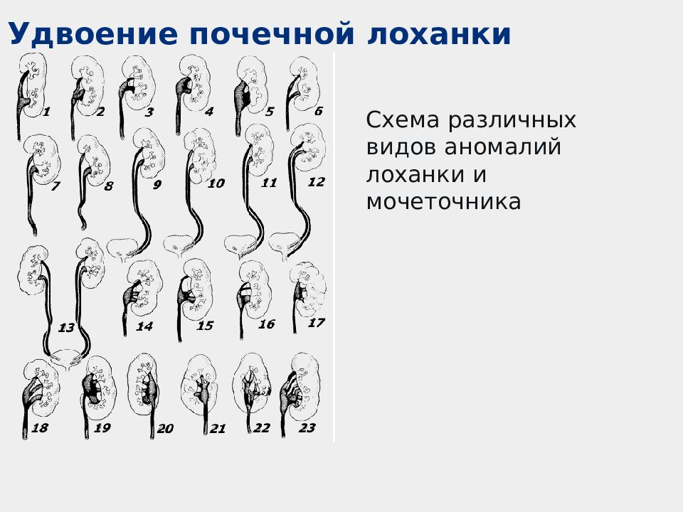 Удвоение почки. Аномалии развития почек неполное удвоение. Неполное удвоение почки на кт. Неполное удвоение ЧЛС почки. Неполное удвоение чашечно лоханочной системы почки.