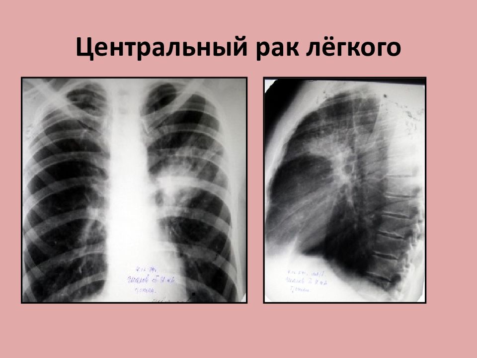 Центральный рак легкого презентация