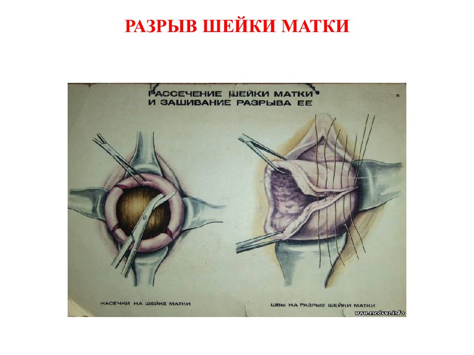 Разрыв шейки матки фото