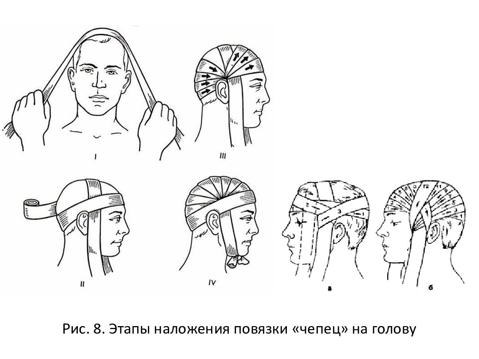 Схема наложения повязки чепец