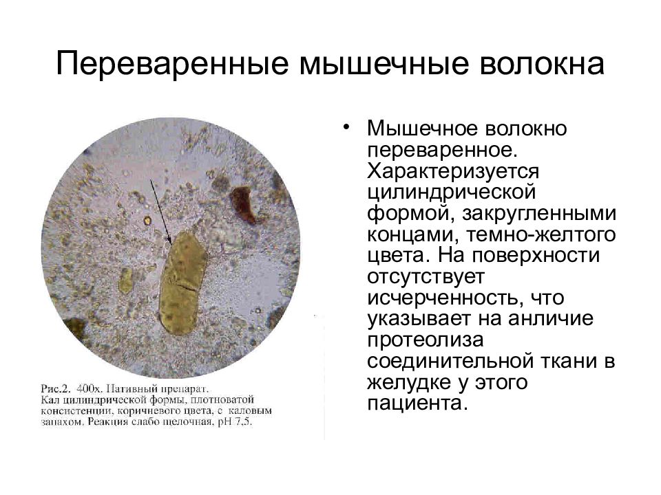 Непереваренные остатки пищи накапливаются в. Переваренные мышечные волокна в Кале. Микроскопия кала мышечные волокна. Мышечные волокна с исчерченностью в микроскопии кала. Микроскопия кала переваренные мышечные волокна.