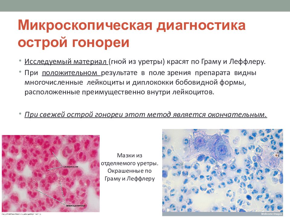 Вагинит микроскопическая картина