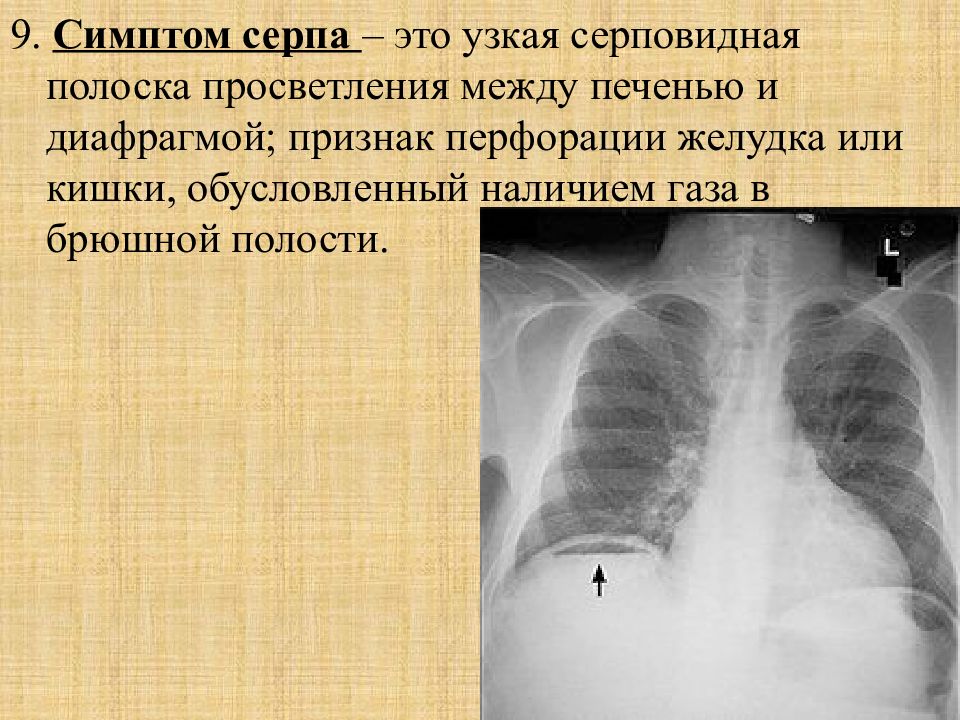 Полость признак. Свободный ГАЗ В брюшной полости рентген. Свободный ГАЗ под куполом диафрагмы рентген. ГАЗ под диафрагмой рентген. Пневмоперитонеум брюшной полости на рентгене.