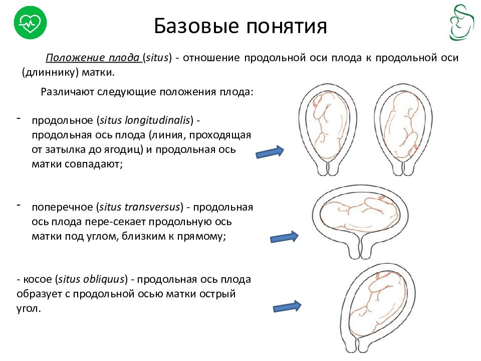 Тазовое предлежание плода акушерство презентация