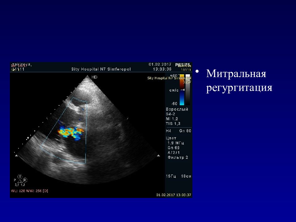 Что означает регургитация 1. Митральная регургитация эхокардиография. Эхокардиография фото. Эхокардиография презентация. Аортальная регургитация эхокардиография.