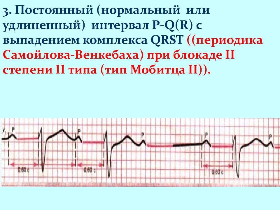 Выпадение комплекса. АВ блокада 2 степени Мобитц 1 с периодикой Самойлова Венкебаха. Периодика Самойлова Венкебаха на ЭКГ. АВ-блокада 2 степени Венкебаха. Периоды Самойлова-Венкебаха на ЭКГ.