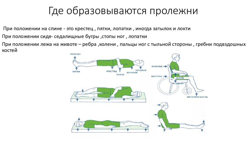 Положение развития. Перечислите места возможного образования пролежней. Места локализации пролежней таблица. Первый симптом образования пролежней. Места образования пролежней при положении сидя.