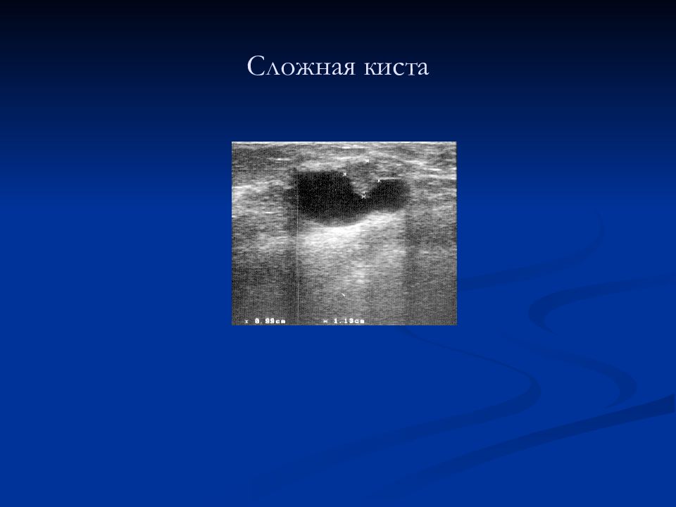 Киста молочной. Атипичная киста в молочной железе. Атипическая киста молочной железы. Атипичная киста молочной железы УЗИ.