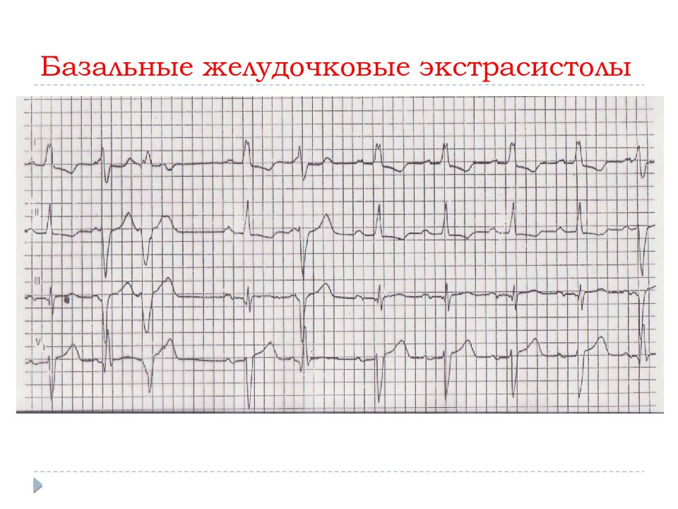 Желудочковая экстрасистолия карта вызова