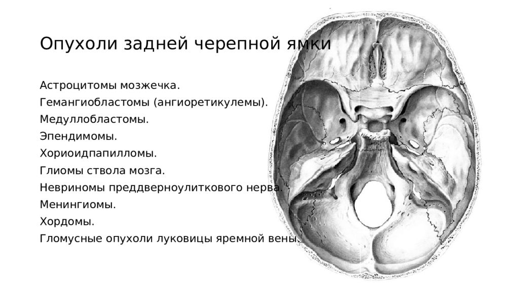 Черепные ямки. Опухоли задней черепной ямки. Задняя черепная ямка анатомия головного мозга. Объемное образование задней черепной ямки. Средняя черепная ямка анатомия кт.