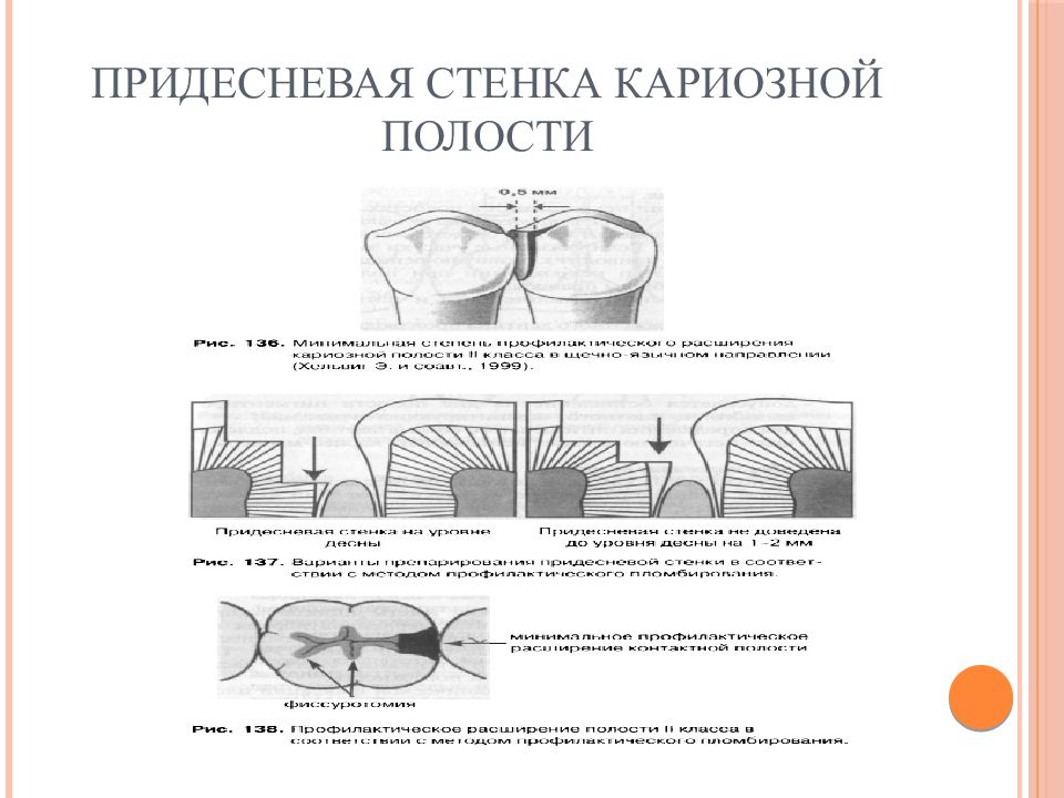 Придесневая стенка в полостях 5 класса формируется под углом