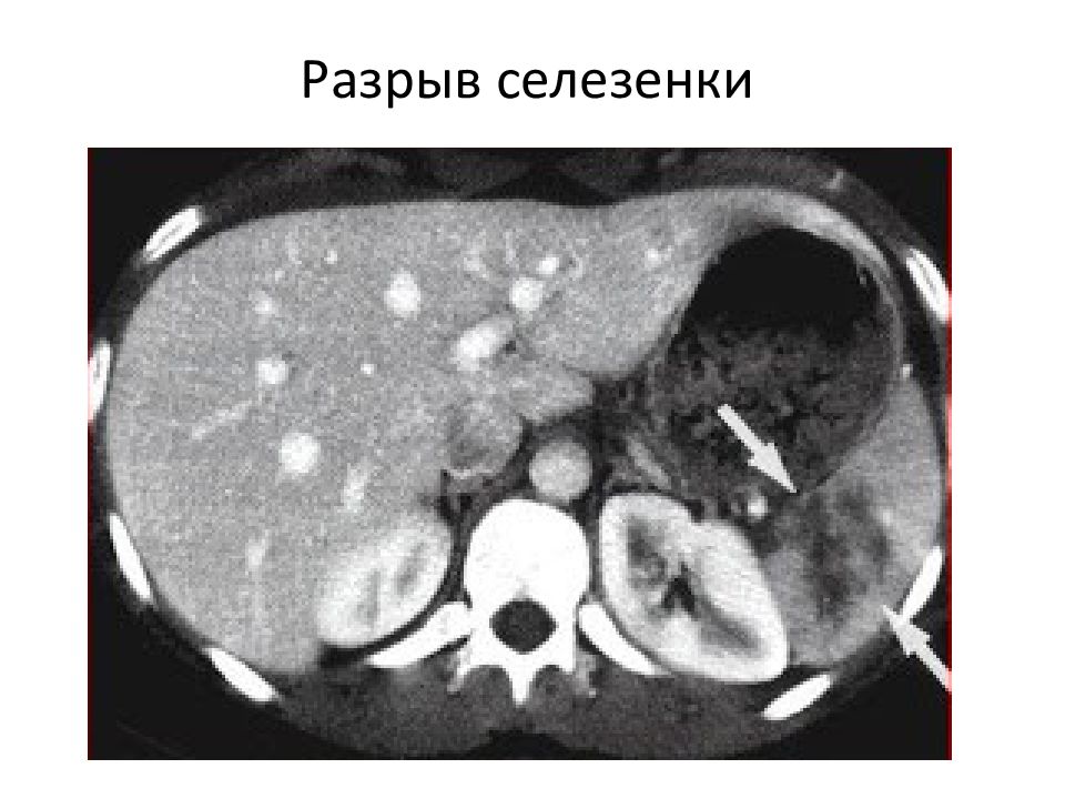 Исследование печени