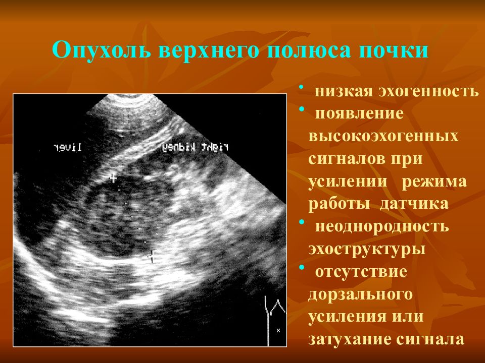 Пониженная эхогенность печени