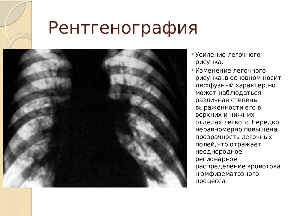 Усилен бронхо сосудистый рисунок