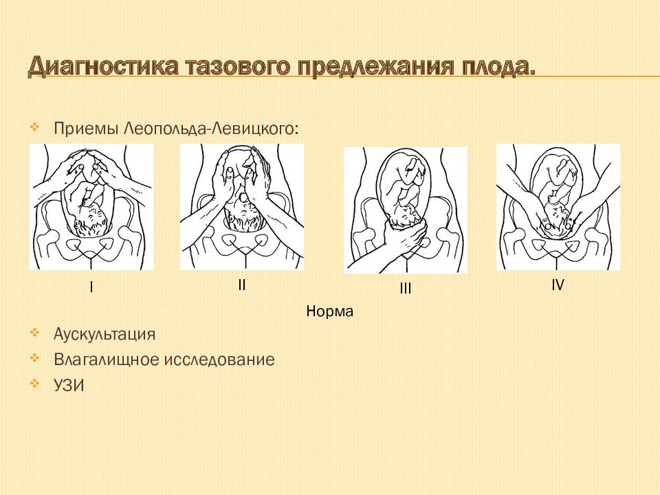 Тазовое предлежание презентация