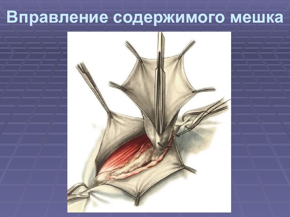 Презентация по грыжам живота