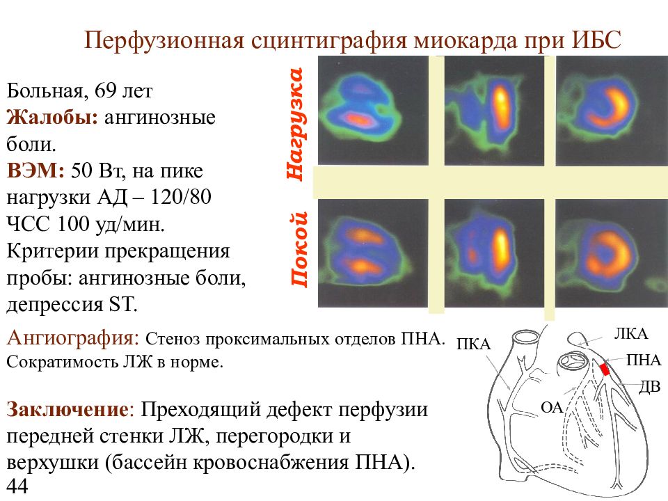 Презентация сцинтиграфия миокарда