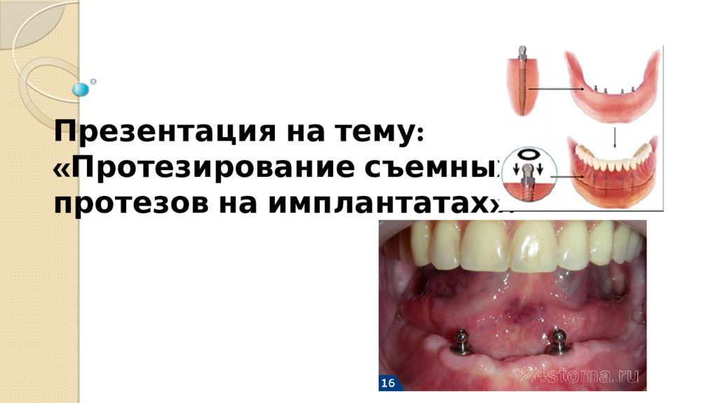 Презентация на тему: « Протезирование съемных протезов на имплантатах».