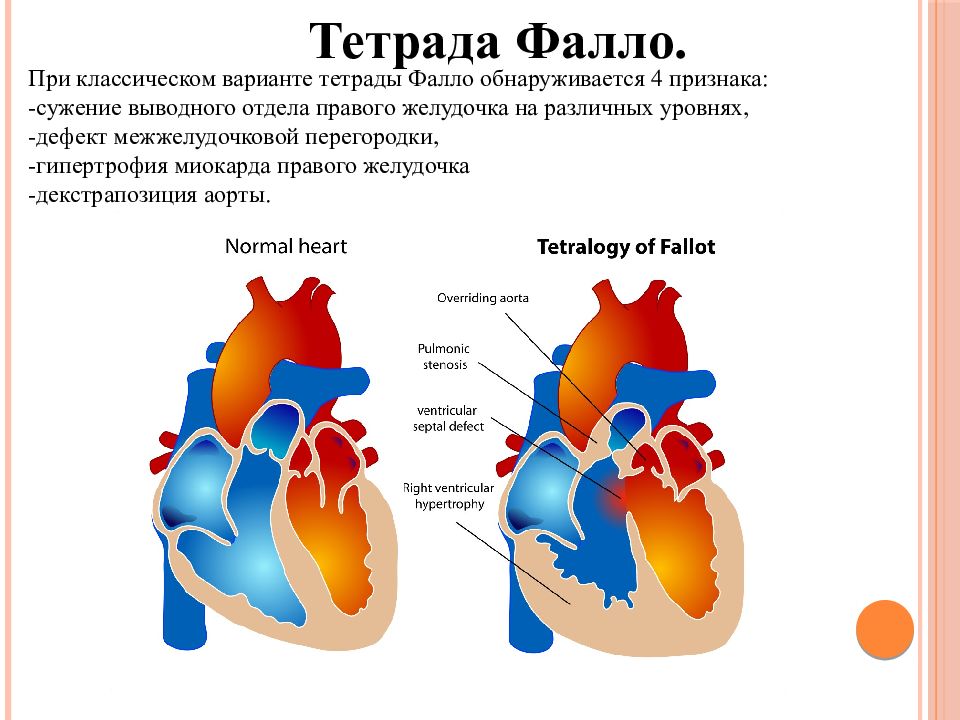 Тетрада фалло гемодинамика схема