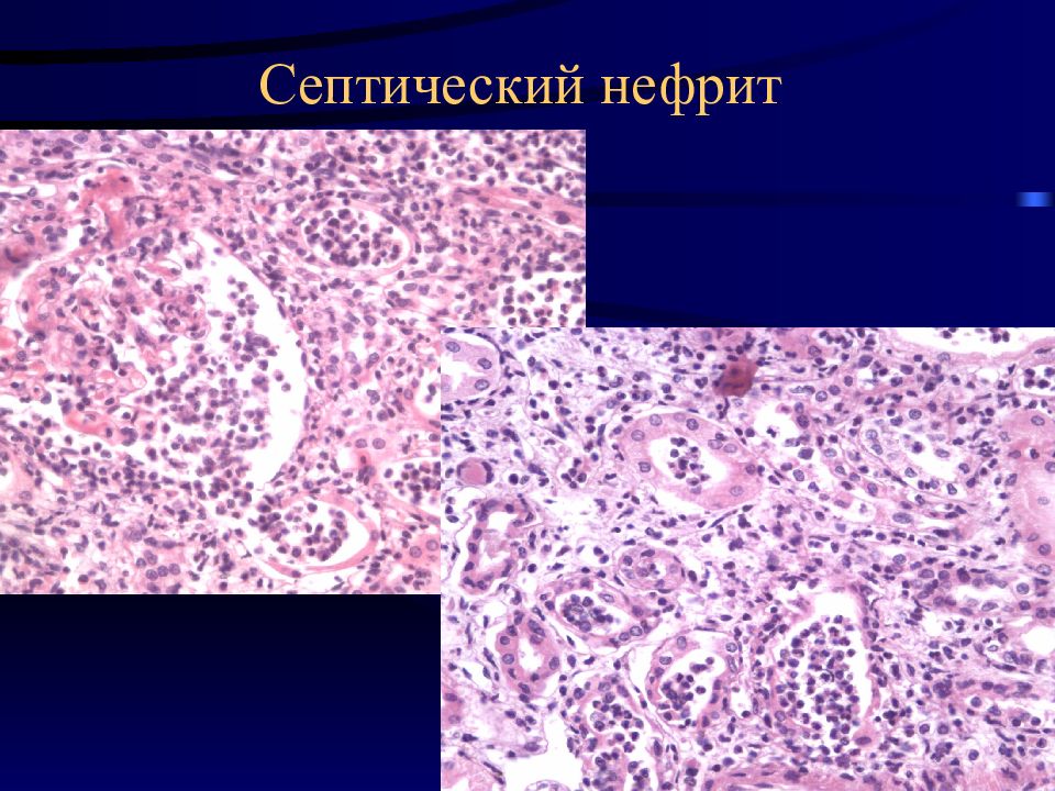 Патологическая анатомия презентации. Септический эндометрит патанатомия. Септический эмболический нефрит. Острый Гнойный эндометрит патанатомия. Септический эндометрит микропрепарат.