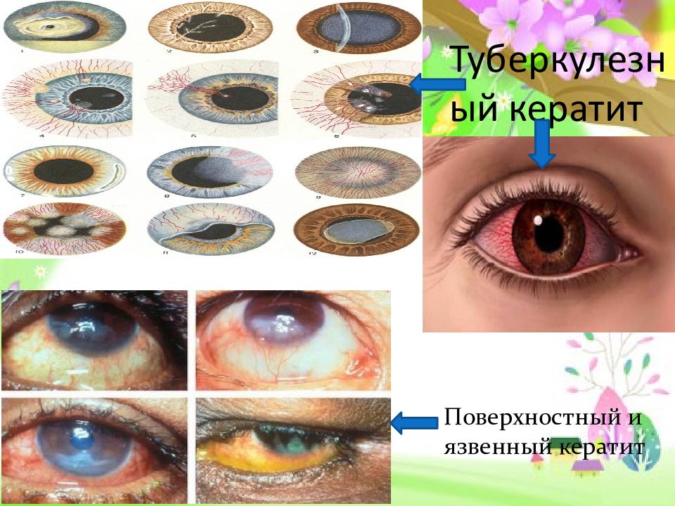 Экзогенные кератиты презентация