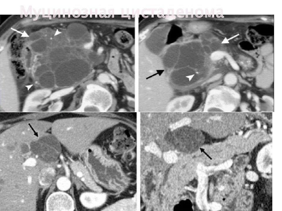 Муцинозная цистаденома поджелудочной железы. Муцинозная цистаденома поджелудочной железы кт. Цистаденома поджелудочной железы кт. Муцинозная кистозная опухоль поджелудочной железы кт. Серозная цистаденома поджелудочной железы кт.