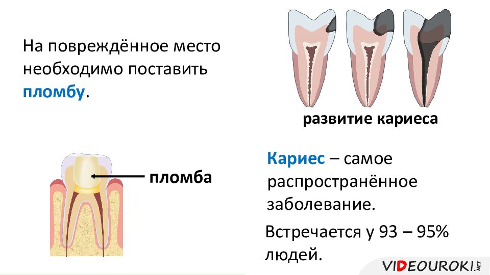 Виды кариеса зубов с картинками