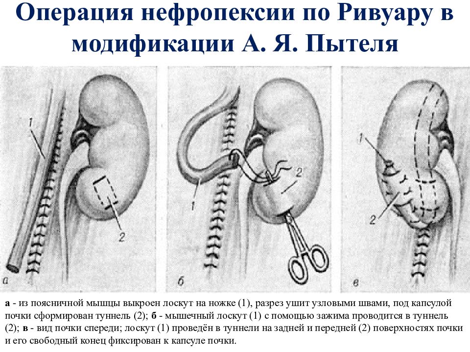 Нефропексия Пытеля Лопаткина. Операция Пытеля Лопаткина. Операция при нефроптозе почки. Нефропексия по методу Ривуара в модификации Пытеля-Лопаткина.