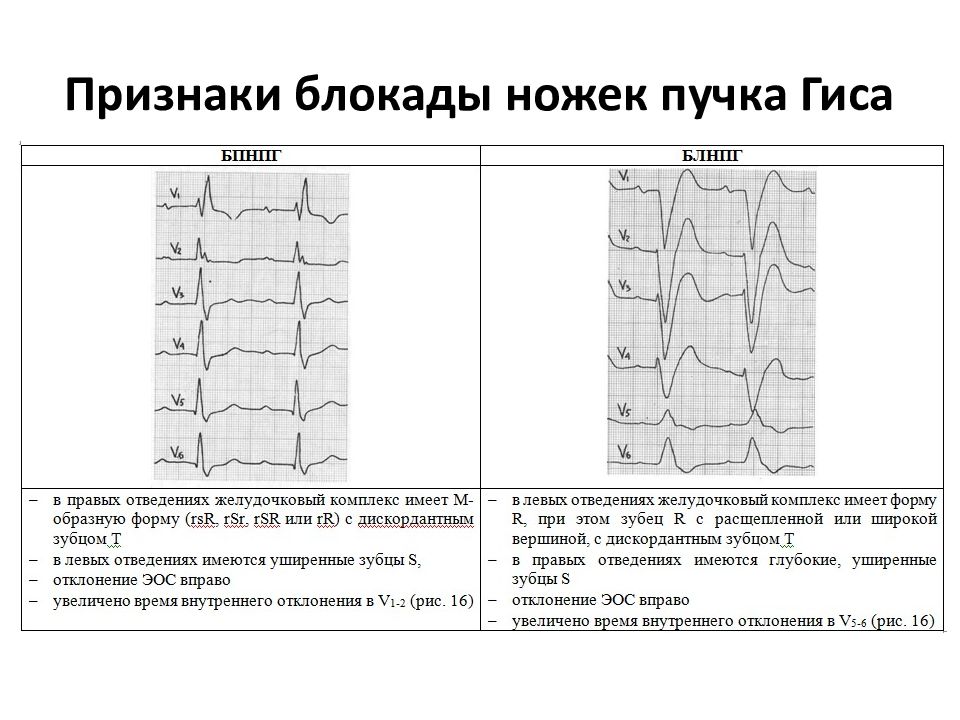 Блокада ножки гиса симптомы. ЭКГ критерии блокады правой ножки пучка Гиса. ЭКГ критерии блокады левой ножки пучка Гиса. Признаки полной блокады правой ножки пучка Гиса на ЭКГ. Полная блокада правой ножки пучка Гиса на ЭКГ.