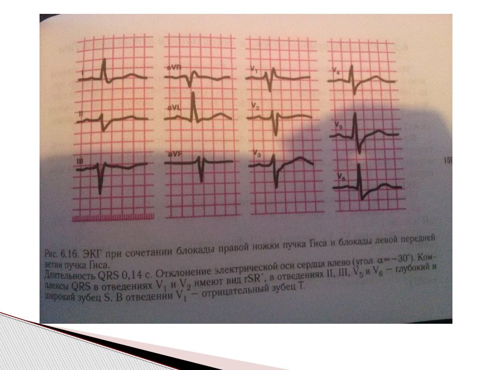 Ветви левой ножки пучка гиса. ЭКГ при блокаде левой ножки пучка Гиса. Критерии блокады левой ножки пучка Гиса. ЭКГ при неполной блокаде правой ножки пучка Гиса. Блокада обеих ножек пучка Гиса ЭКГ.