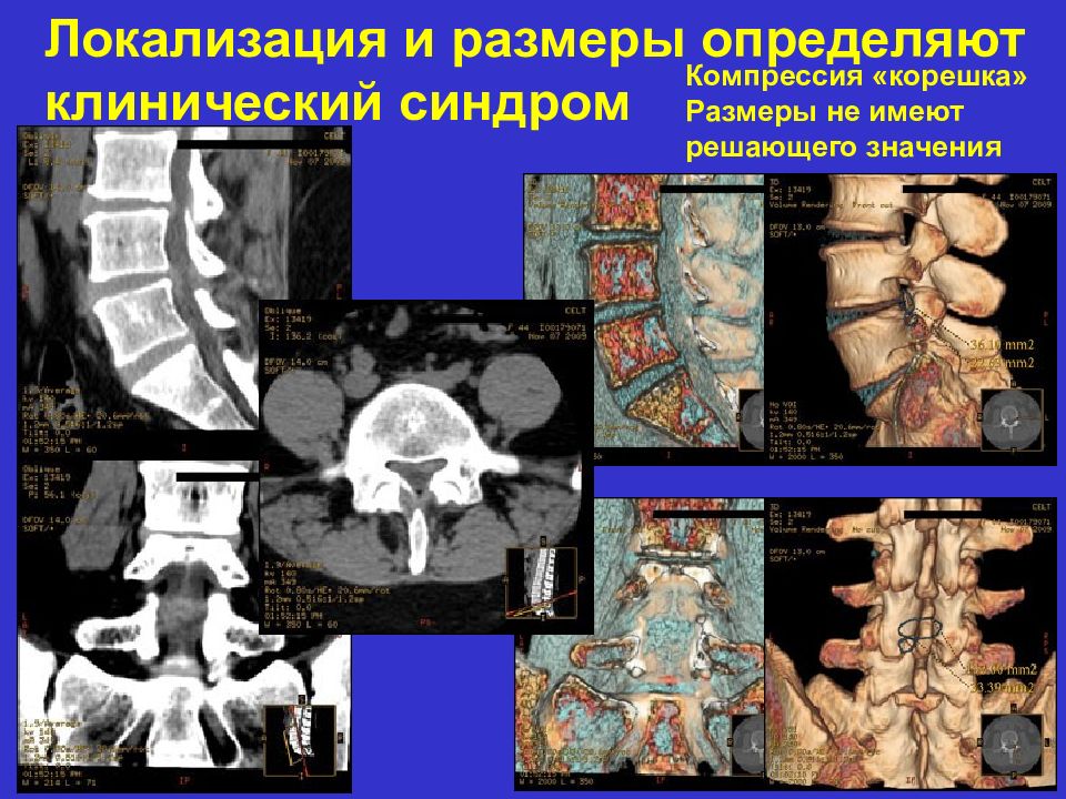 Компрессия корешков поясничного отдела