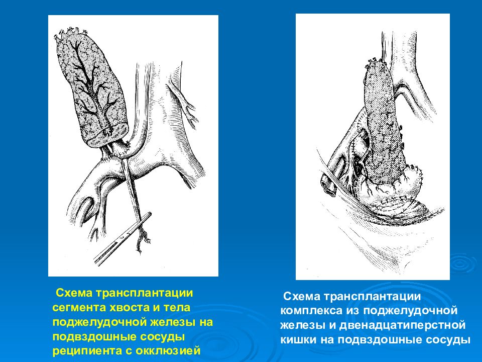 Трансплантация кишечника. Сегментированный хвост.