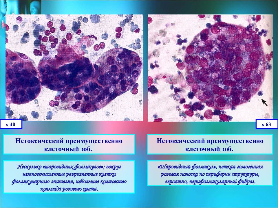 Цитологическая картина коллоидного узла