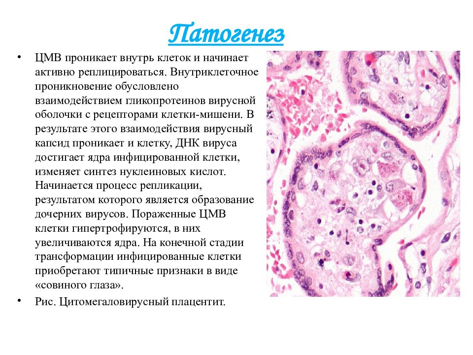 Цитомегаловирусная инфекция патогенез схема