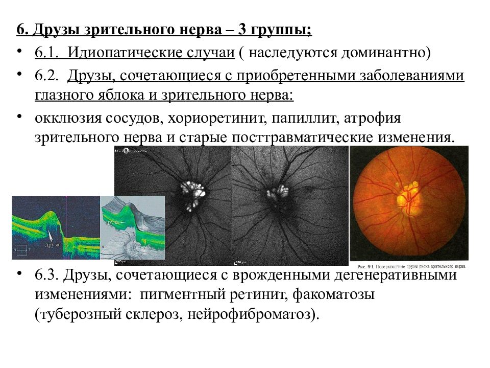 Заболевания сетчатки и зрительного нерва презентация