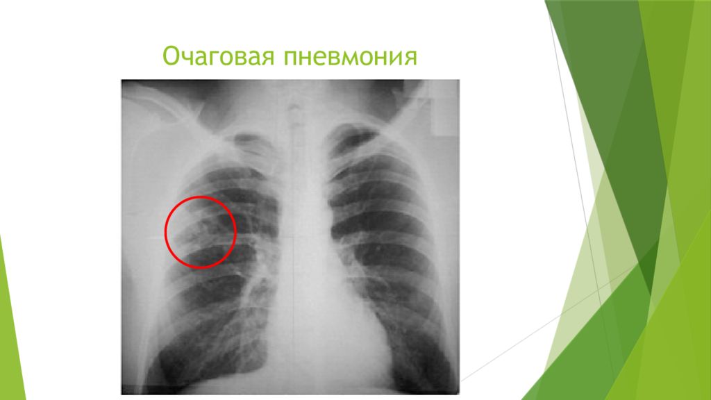 Очаговая пневмония. Очагово сливная пневмония рентген. Очаговая бронхопневмония рентген. Очаговая пневмония легкого рентген. Правосторонняя очаговая пневмония рентген.