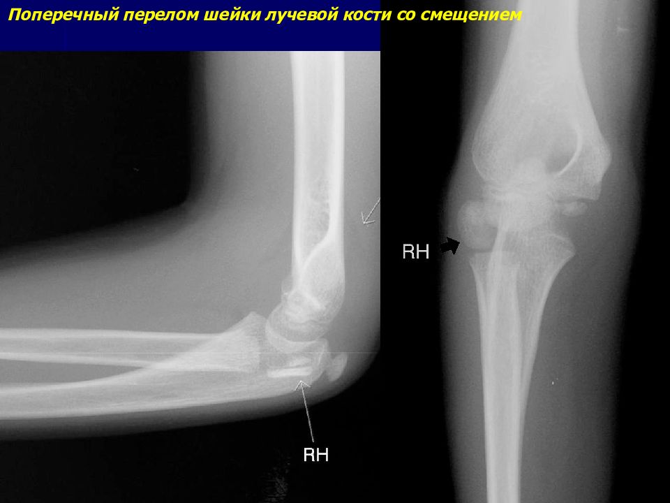 Перелом лучевой и локтевой кости у ребенка. Остеофит локтевого отростка рентген. Экзостоз локтевого отростка рентген. Перелом локтевого отростка рентген. Обызвествление локтевого отростка рентген.