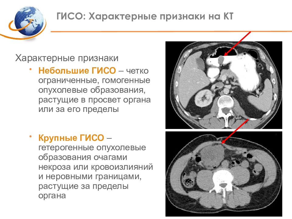 Гисо желудка