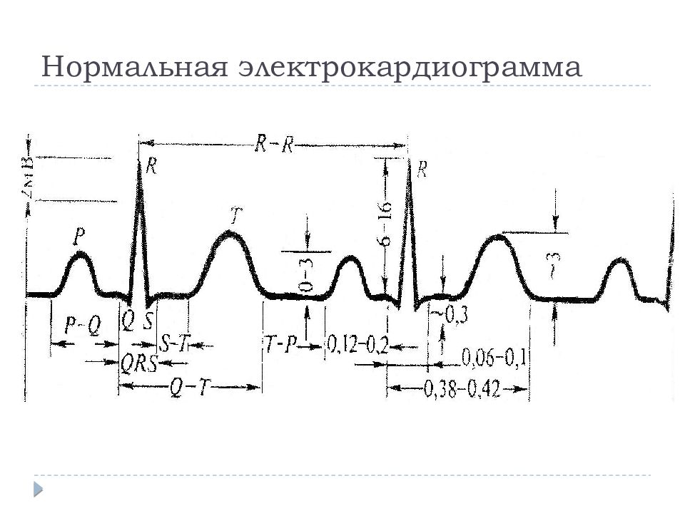 Экг норма. Схема ЭКГ В норме. Схема нормальной ЭКГ человека. ЭКГ снимок норма схема. Нормальные параметры ЭКГ ЧСС.