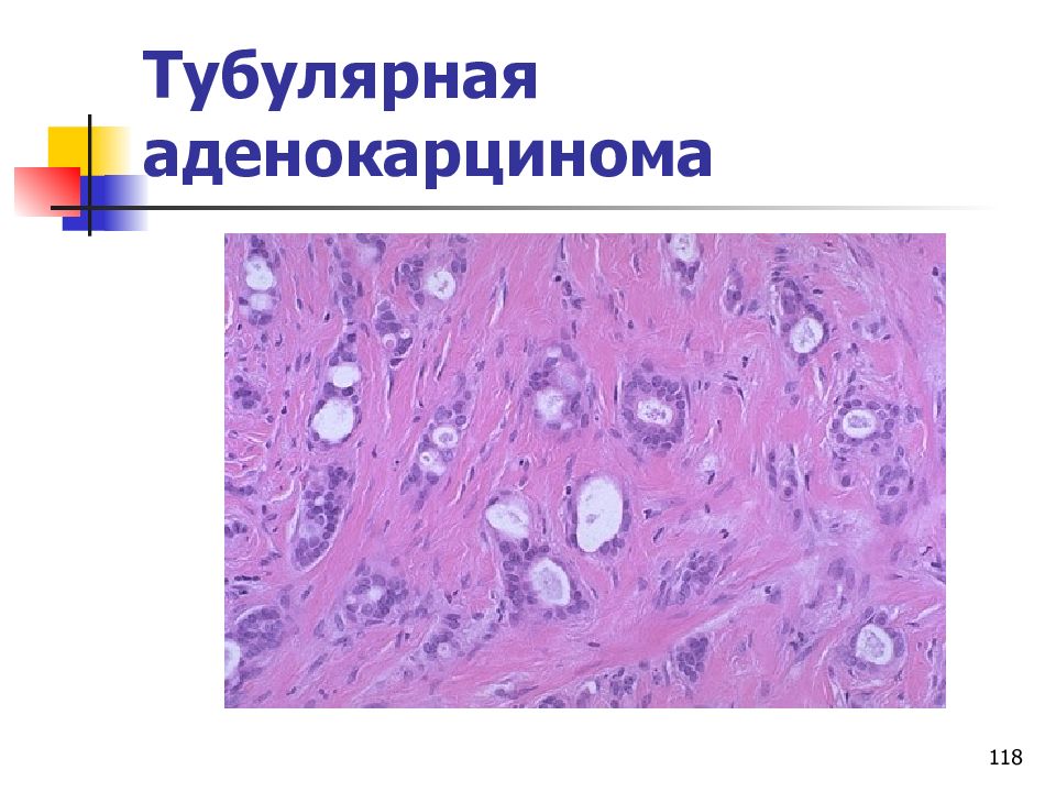 Аденокарцинома желудка. Тубулярная аденокарцинома желудка гистология. Тубулярная аденокарцинома желудка микропрепарат. Аденокарцинома эпителиальная. Тубулярная папиллярная муцинозная аденокарцинома.