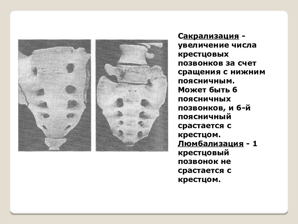 Сросшиеся крестец. Люмбализация s1 позвонка рентген. Люмбализация s1 позвонка кт. Неполная сакрализация l5 позвонка рентген. Люмбализация s1 позвонка мрт.