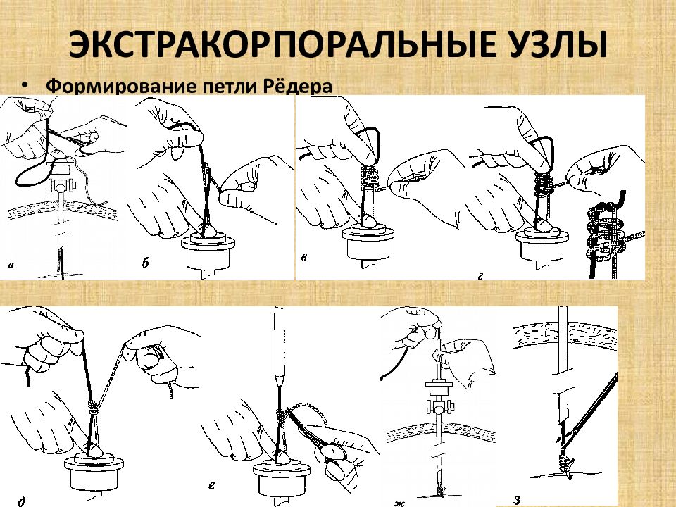 Формирование узлов. Петля Редера. Узел Редера. Экстракорпоральный шов. Экстракорпоральный шов в лапароскопии техника.