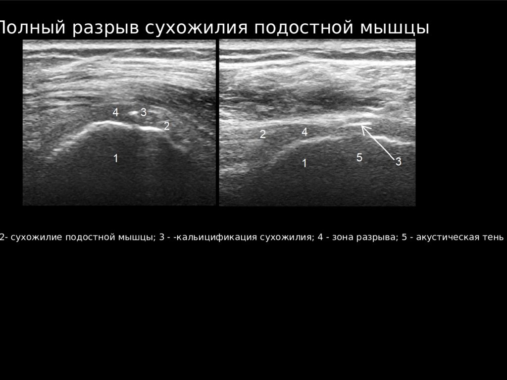 Узи плечевого. Бурсит плечевого сустава на УЗИ. Надрыв сухожилия плечевого сустава УЗИ.