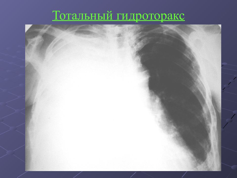 Гидроторакс это. Тотальный правосторонний плеврит. Тотальный правосторонний плеврит рентген. Левосторонний Тотальный гидроторакс. Тотальный экссудативный плеврит рентген.