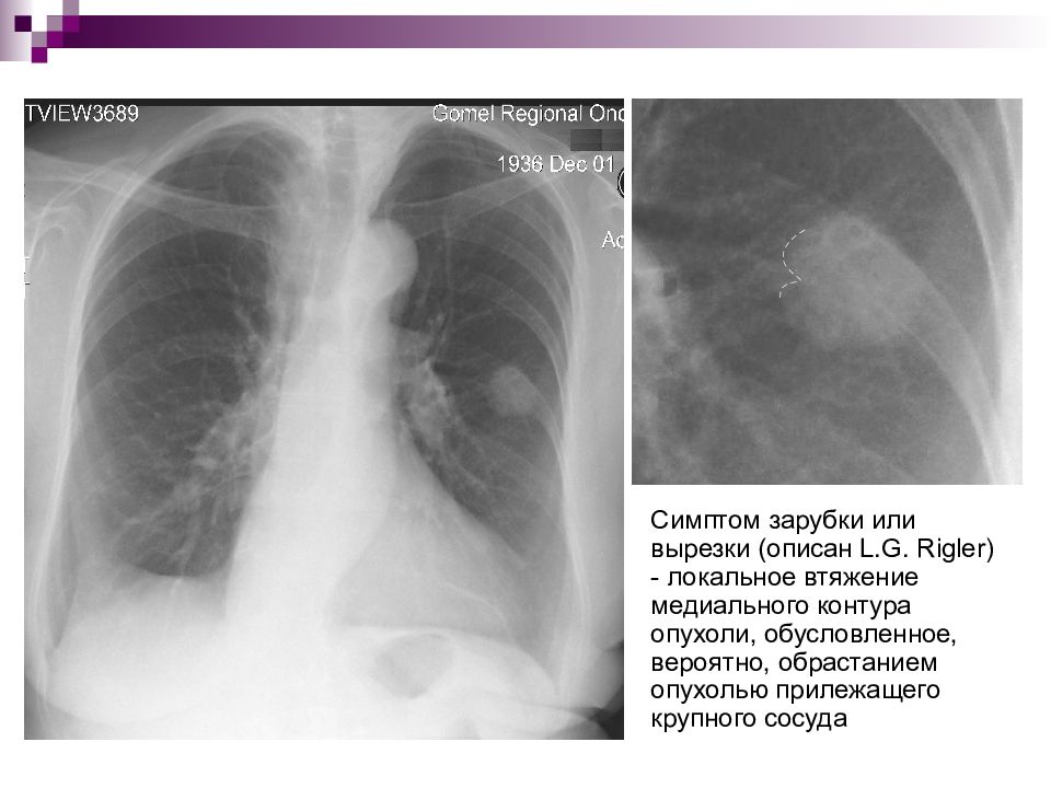 Лучевая диагностика рака легкого презентация