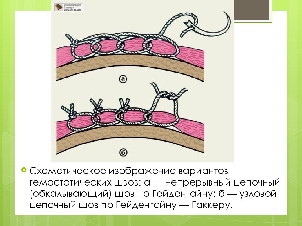 Хирургические швы презентация