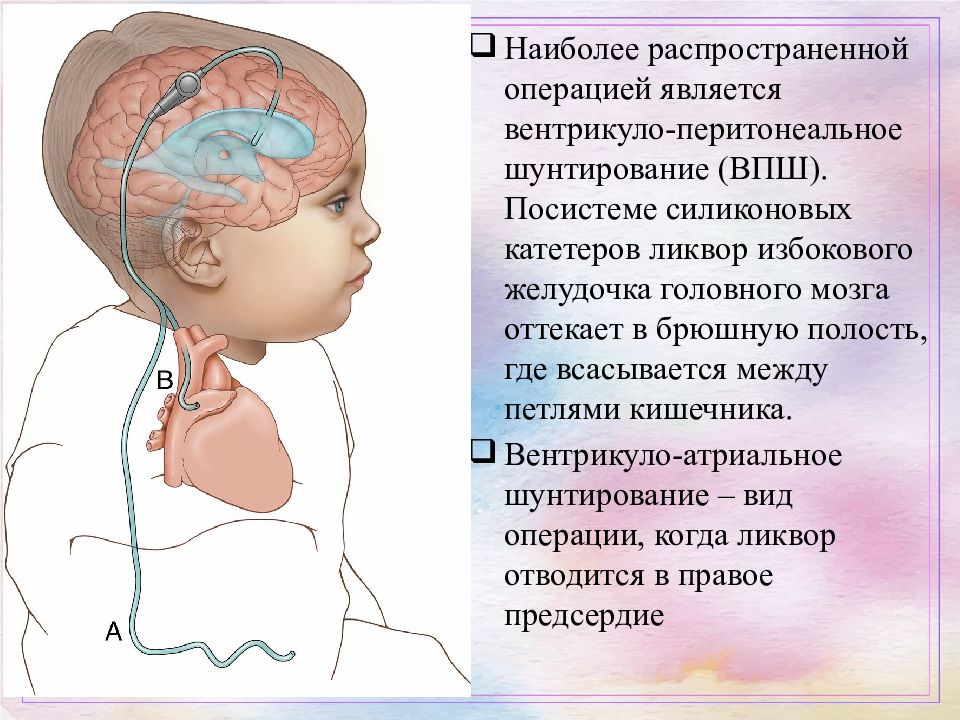 Картина смешанной гидроцефалии